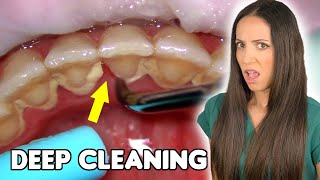 Deep Cleaning With HEAVY Tartar Build Up At The Dentist [upl. by Golub]