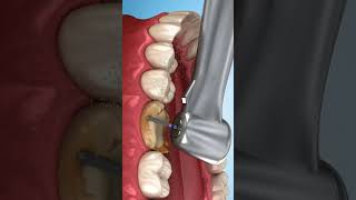 ازالة التسوس وتركيب تلبيسة للضرس Removal of caries and installation of a crown for the molar doctor [upl. by Ogu]