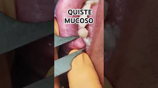 shorts QUISTE Mucoso 👅 Oral FIBROMA [upl. by Ellenod]