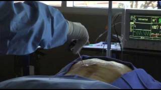 Osteoporosis Pain Watch this Vertebroplasty Procedure  Live [upl. by Lejeune]