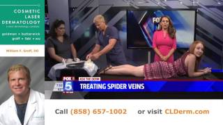 Treating Spider Veins [upl. by Irahcaz]