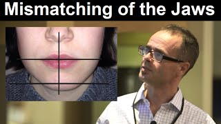 Effect of Midline Discrepancy Mismatching or Facial Asymmetry on Facial Appearance by Dr Mike Mew [upl. by Kironde473]