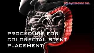 Colorectal Stent [upl. by Lanctot314]