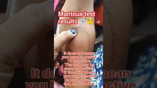 mantoux test result 🧐ytshorts shorts youtubrshortslaboratory medicalstudent dmlt bmlt [upl. by Gottuard]