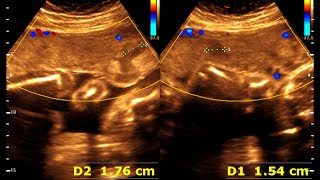 25 weeks 0 days pregnancy  Normal pregnancy  Placental lake [upl. by Ahsoet]