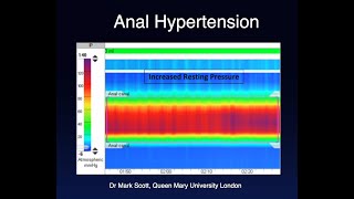 Anorectal Disorders  An Expert Review [upl. by Hoy]