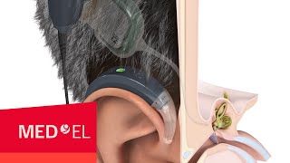 Wie funktioniert ein CochleaImplantat  MEDEL [upl. by Neenej41]