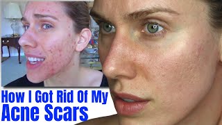 Acne  Scar Update How I Got Rid Of My Acne Scars [upl. by Rosio]