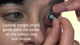 GP contact lens removal with sucker [upl. by Hesky]