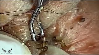 Elderly Hidden Blackhead Removal  Cystic Acne Treatment  Pimple Popping Spa  Acne on Face  079 [upl. by Inah849]