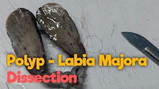 Polyp  Labia Majora Dissection [upl. by Aramal]