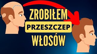 Przeszczep włosów  a po co to komu [upl. by Questa5]