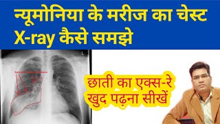 How to Read Chest Pneumonia XRay Findings  फेफड़े का एक्सरे कैसे समझे [upl. by Anama164]