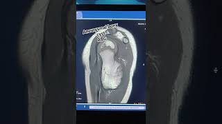 bone aneurysmal cyst mri mri [upl. by Anrim278]