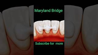 maryland bridge  fix teeth  shorts viral dental asmr [upl. by Aehsa352]