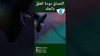 التصاق دودة العلق بالجلد  بداية أمل للتمريض المنزلي [upl. by Janith]