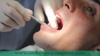 refaire toutes ses dents implant dentaire [upl. by Ailimaj]