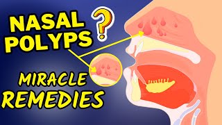 Best Natural Remedies For Nasal Polyps  How To Treat Nasal Polyps At Home Naturally [upl. by Gamaliel909]