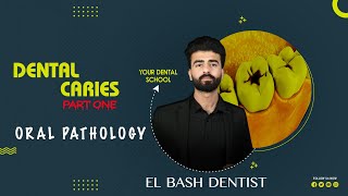 dental caries  part 1  oral pathology  عزت شومان [upl. by Chrotoem]