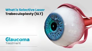 What is Selective Laser Trabeculoplasty SLT  Glaucoma Treatment 3D [upl. by Ahseram122]