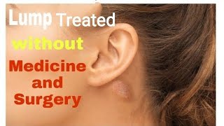 Lump Cyst behind Ear Swollen Glands Adenopathytreated without Medicine and Surgery। Home Remedy [upl. by Mohl190]