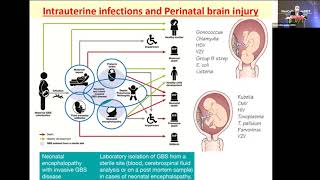 Neonatal encephalopathy thinking beyond HIE…but when [upl. by Nyret]