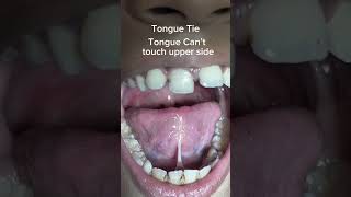 Unlock Proper Tongue Movement Now speech therapy [upl. by Otxilac]