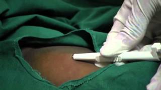 Contraceptive Implants  11  Procedure Insert implant [upl. by Bryana]