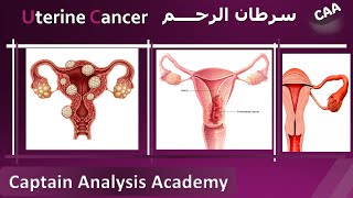 E4Endometrial Cancer Uterine cancer سرطان الرحم اسبابة وطرق تشخيصة و علاجه [upl. by Elish]