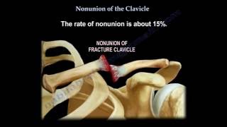 Nonunion Of The Clavicle  Everything You Need To Know  Dr Nabil Ebraheim [upl. by Llewoh]