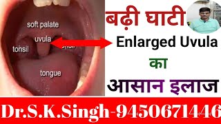 Uvula Swollen SymptomsUvulitis TreatmentGhati Badhane Par Kya kare [upl. by Marena303]