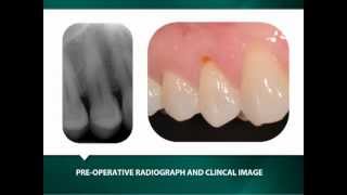 Bicon SHORT Implant Placement and Restoration with an IAC [upl. by Derron]