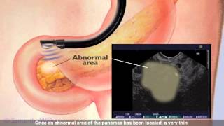 Endoscopic Ultrasound [upl. by Aleil]