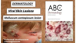 DERMATOLOGY Viral skin lesions  molluscum contagiosum lesions derma lesion viral [upl. by Enerehs902]