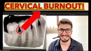 Cervical Burnout or Caries How to Know theories of dental caries in teeth cavity ICDAS x ray [upl. by Elsilrac672]