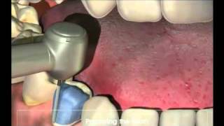 Crowns  Procedure for your new crown at Dental Reflections [upl. by Keviv817]