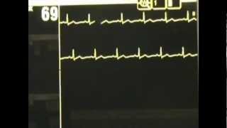 Normal Sinus Rhythm  ACLS Rhythm Recognition and Guidelines [upl. by Adidnere]