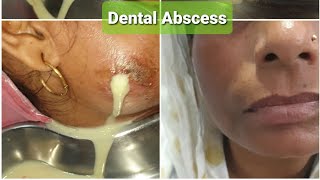 dental abscess drain IampD OralDentalCare DDC [upl. by Valerle]