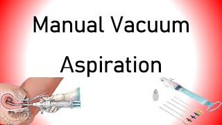 Manual Vacuum Aspiration MVA [upl. by Ainollopa]