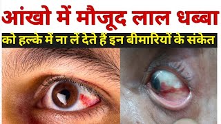 आंख लाल होने का कारण  subconjunctival hemorrhage in hindi  subconjunctival hemorrhage treatment [upl. by Bobbee]