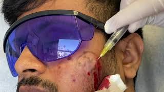 Subcision for Acne Scars [upl. by Amery]