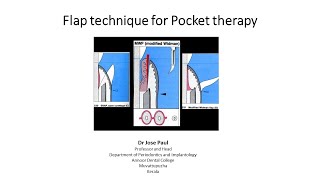 Flap technique for pocket therapy [upl. by Otho]