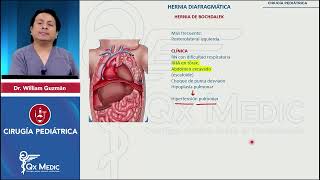 Malformaciones del diafragma Hernia de Bochdalek  Cirugía en Pediatría 2024 [upl. by Cutter]