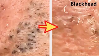 【角栓除去】しぶとい！大量のニキビを芯出しするのって気持ちいい／Blackhead Removal Show [upl. by Glynas295]