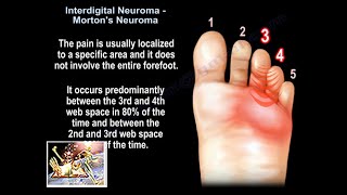 Interdigital Neuroma Mortons Neuroma  Everything You Need To Know  Dr Nabil Ebraheim [upl. by Andrei]