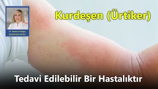 Kurdeşen Ürtiker Tedavi Edilebilir Bir Hastalıktır  Dr Aslıhan Kırkağaç [upl. by Elleinad]