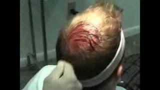 Dr Joseph Greco  Using PRP Therapy For Hair Loss [upl. by Trebled]