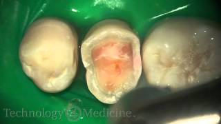 Dental Laser  Crown Prep Extracted [upl. by Glenden]