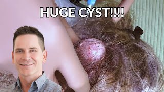 Watch MASSIVE Cyst Get Excised from Patients Head  CONTOUR DERMATOLOGY [upl. by Mialliw]