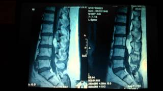 Spine Lecture complex synovial cyst of the lumbar spine [upl. by Rotow943]